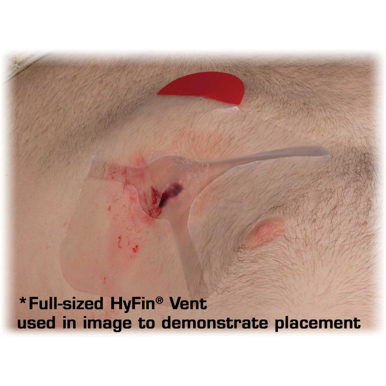 HyFin Vent Chest Seal
